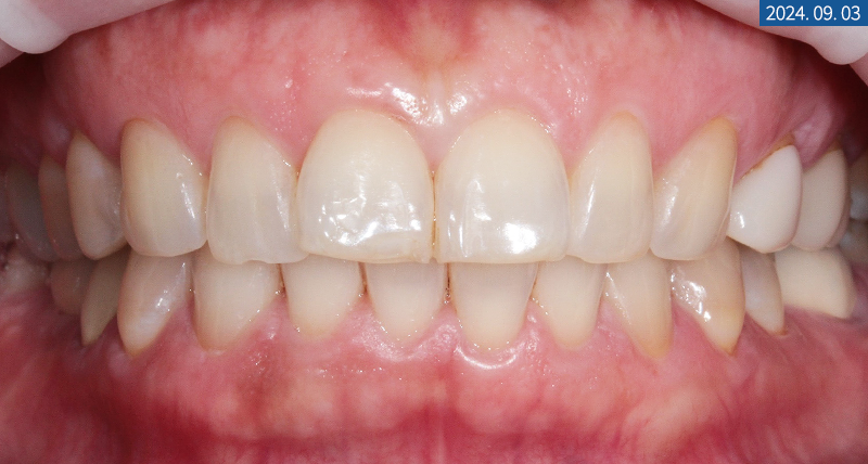 라미네이트전후 치아의 가지런한 정도와 밝기 차이 확인하기 관련 이미지 2