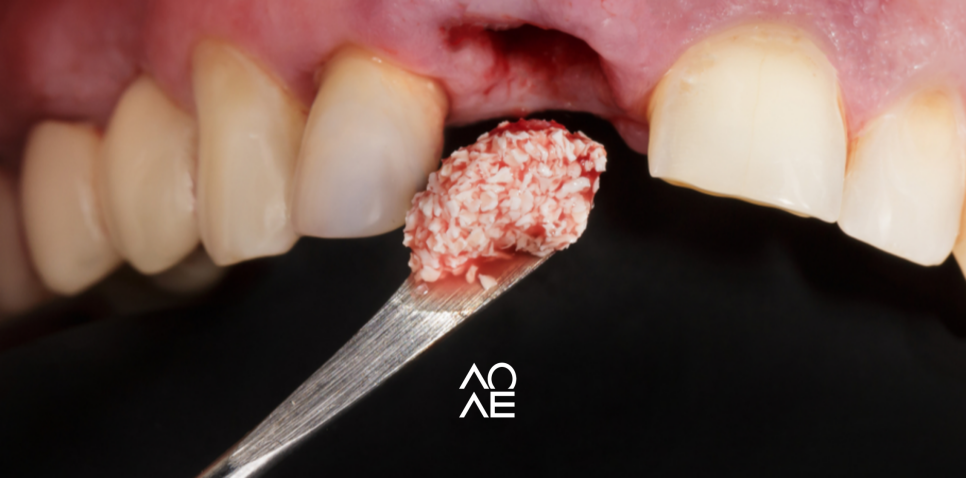 임플란트 뼈이식 필요한 경우 기간은? 관련 이미지 1