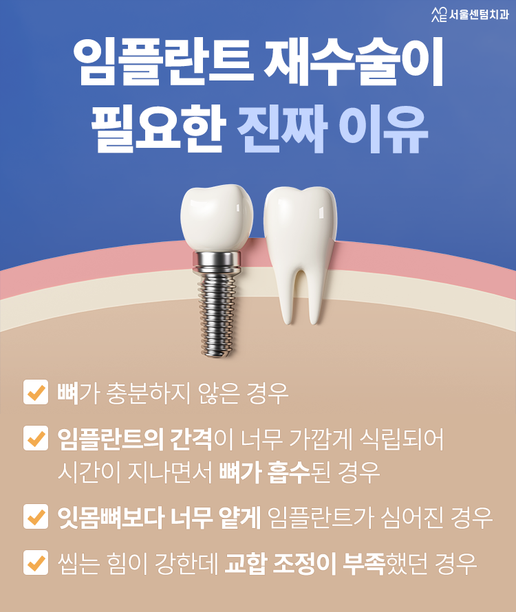 임플란트 재수술 실패가 아니라 처음 선택의 문제일 수 있습니다 관련 이미지 3