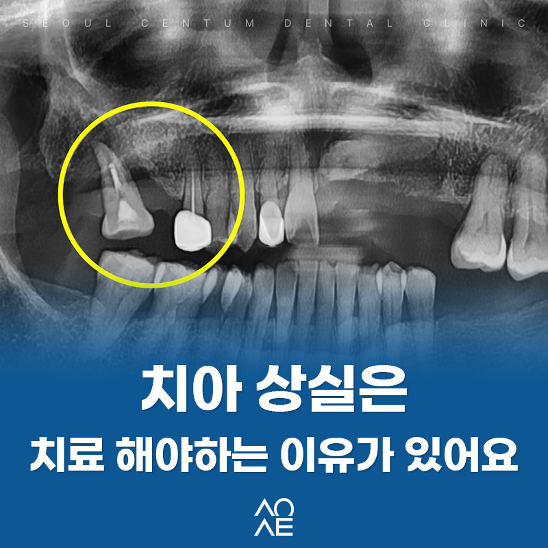 발치 후 임플란트 꼭 해야하는 이유 (잇몸뼈 소실, 쓰러짐, 정출) 관련 이미지 11