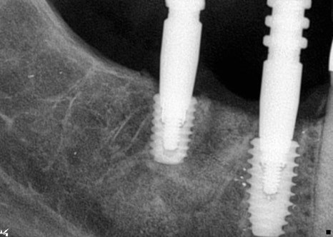 신사역치과 발치후 임플란트 시술과정 30대 남성 케이스 관련 이미지 3
