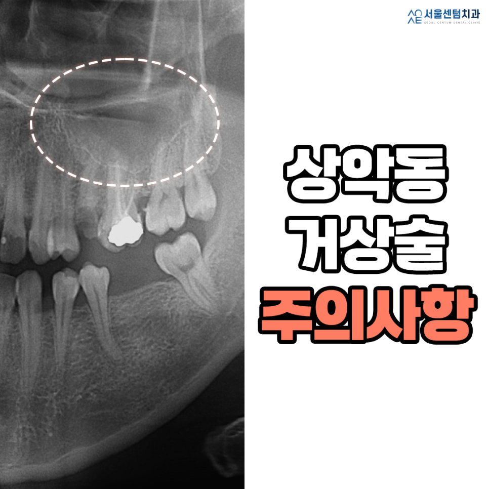 상악동거상술 주의사항 반드시 체크해야할 것 관련 이미지 6