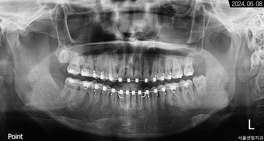 비발치로 돌출입 해소한 증례 관련 이미지 6