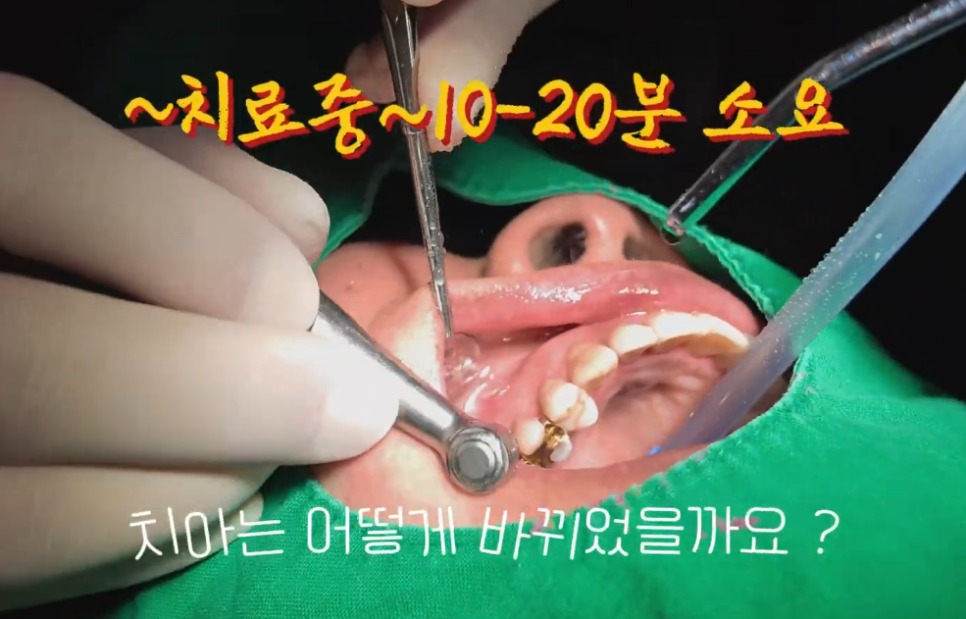 치아패임 이대로 두어도 괜찮을까요 치경부마모증 레진치료 관련 이미지 14