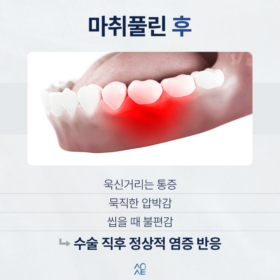 임플란트 4개 동시에 발치하고 식립하면 더 아플까요? 실제 경과 알려드립니다 관련 이미지 3