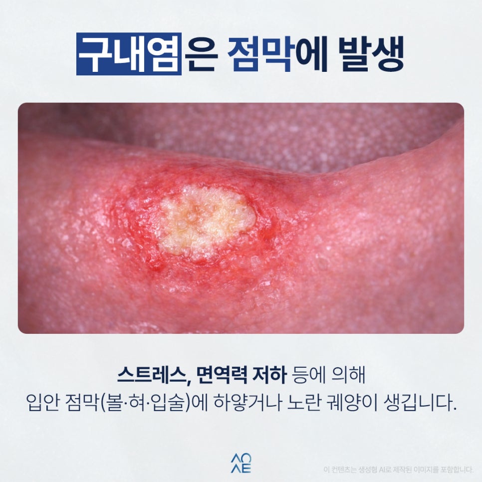 구내염 잇몸염 모두 제대로 예방하고 싶은 분들만 보세요 관련 이미지 2