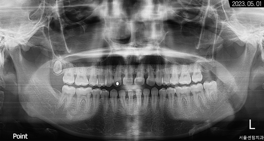 비발치로 돌출입 해소한 증례 관련 이미지 2