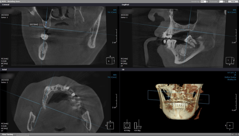 임플란트 브릿지와 크라운 수복으로 치아 기능을 회복시킨 증례 관련 이미지 14