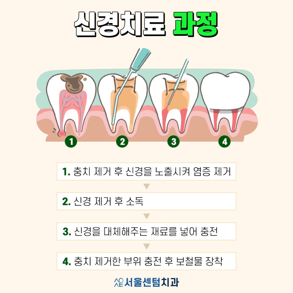 Explaining the Root Canal Treatment Process with Actual Dental Photos image 2