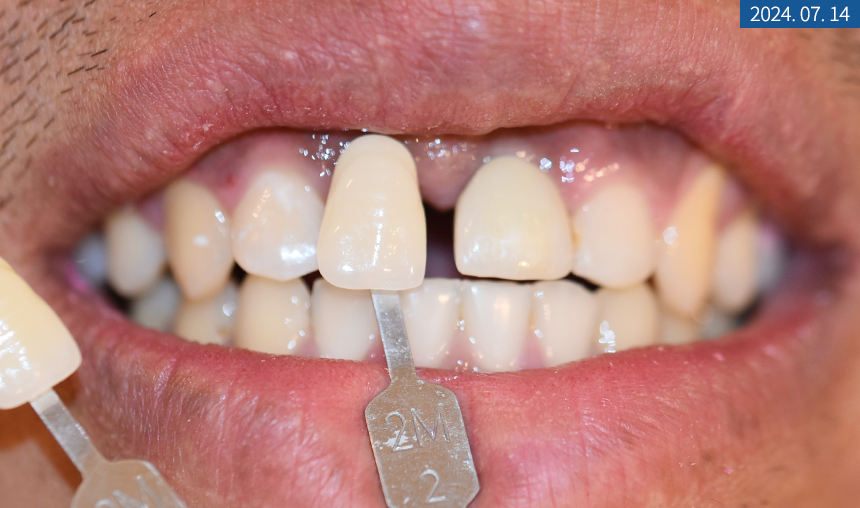앞니 임플란트 식립으로 저작 기능을 끌어올린 증례 관련 이미지 10