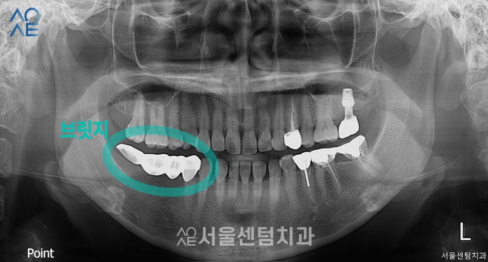 40대임플란트 수술 어떻게 하나요? 관련 이미지 1
