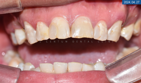 뼈이식 임플란트와 라미네이트 수복 증례 소개 관련 이미지 5