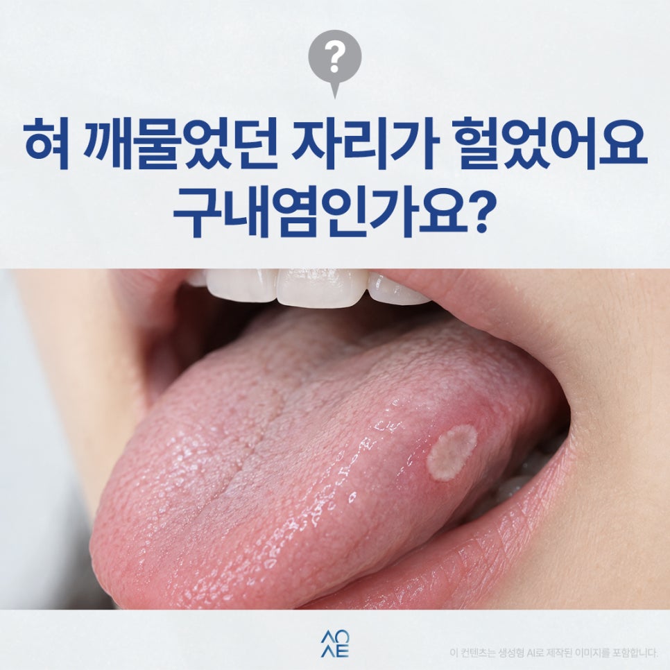 혓바닥 구내염 혀 세게 깨물었다가 생길 수 있는 건가요? 관련 이미지 1
