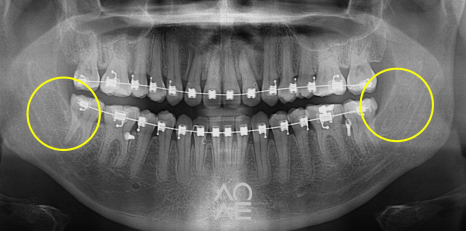 사랑니 발치 통증 붓기 줄이는 법 관련 이미지 8