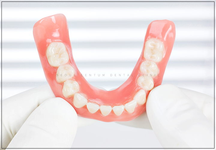 임플란트 뼈이식이 필요한 경우 구체적으로 확인하고 싶다면 관련 이미지 7