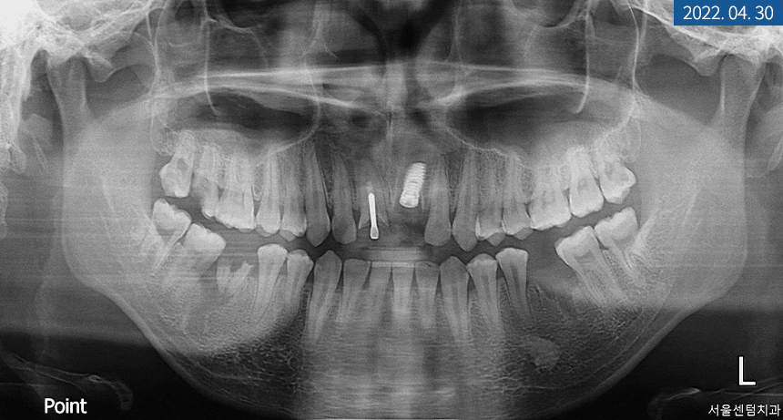 앞니 임플란트 식립으로 저작 기능을 끌어올린 증례 관련 이미지 5