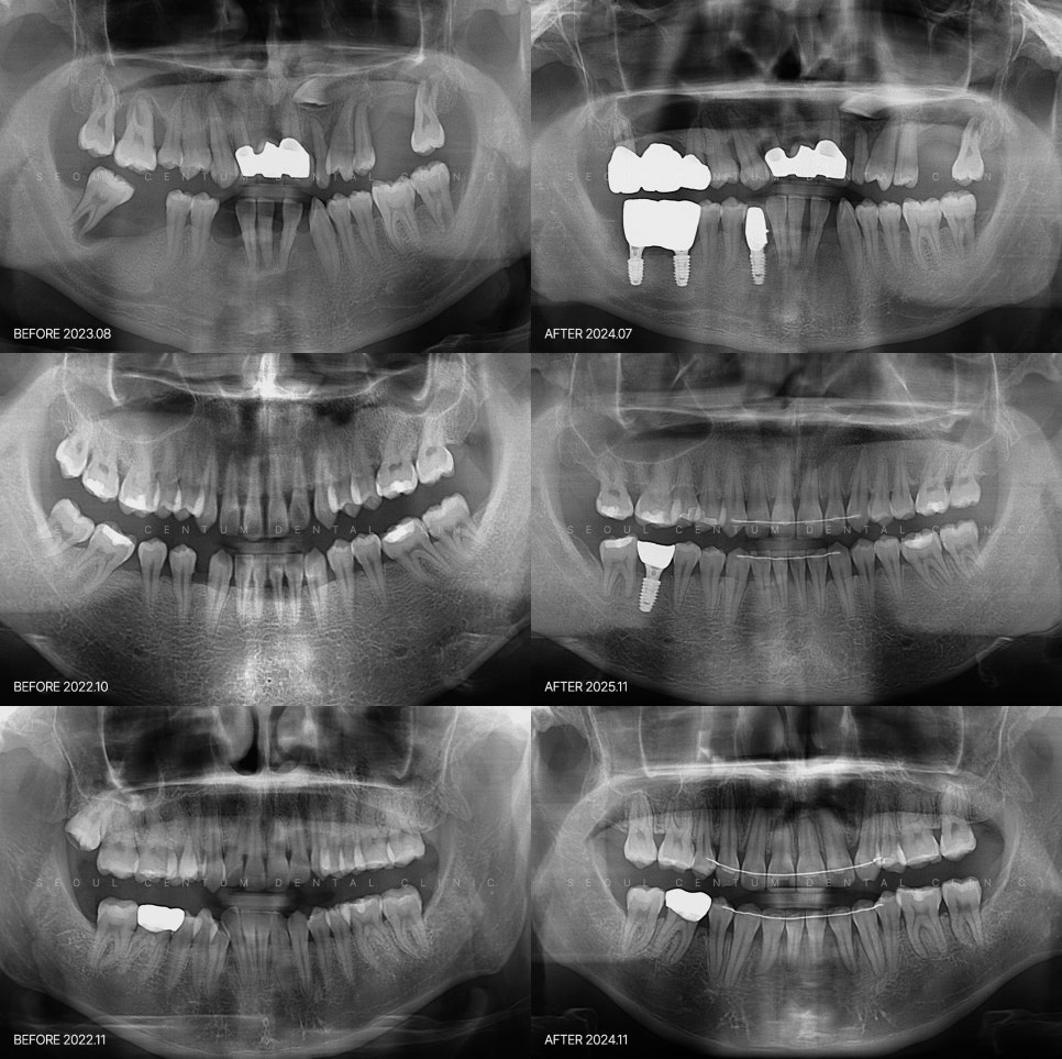 흔들리는 치아 가만히 두지 말고 즉각 치료받아야 하는 경우는? 관련 이미지 6