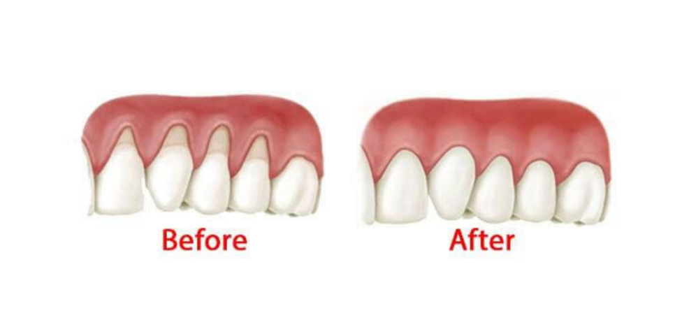 잠원동 스케일링 후 통증 당연히 있을 수 있습니다. 관련 이미지 6