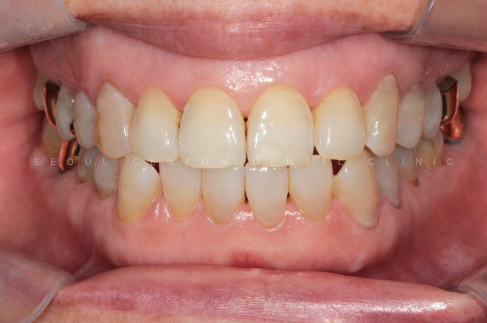 치경부마모증 가격 gi 레진 갈색치아 원인 통증 관련 이미지 9