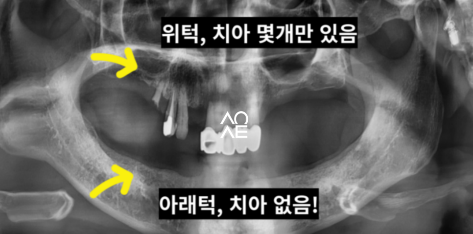 국민 건강보험 임플란트 노인 무치악의 기준은? 관련 이미지 8