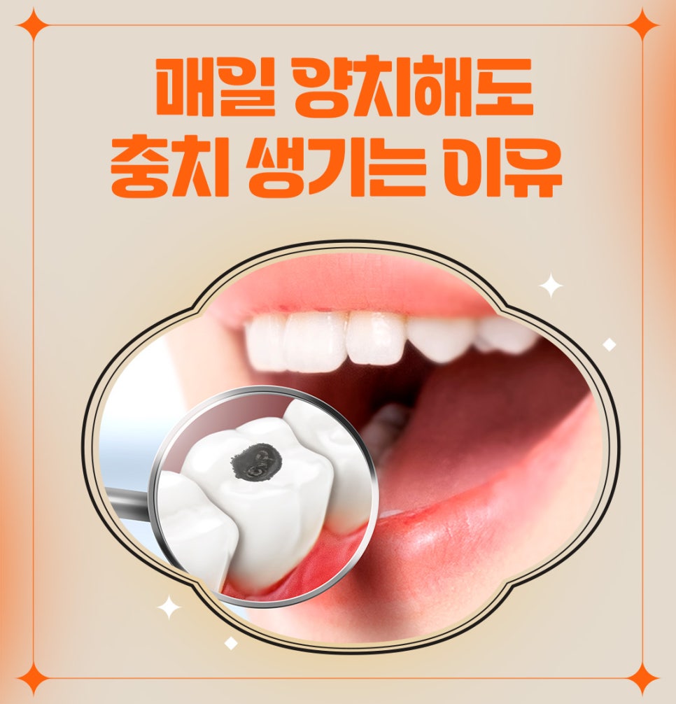 매일 양치해도 충치 생기는 이유 관련 이미지 1