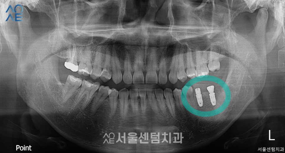 치아 신경치료 단계 임플란트까지 고려한다면 관련 이미지 4