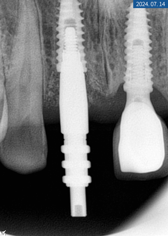 앞니 임플란트 식립으로 저작 기능을 끌어올린 증례 관련 이미지 11