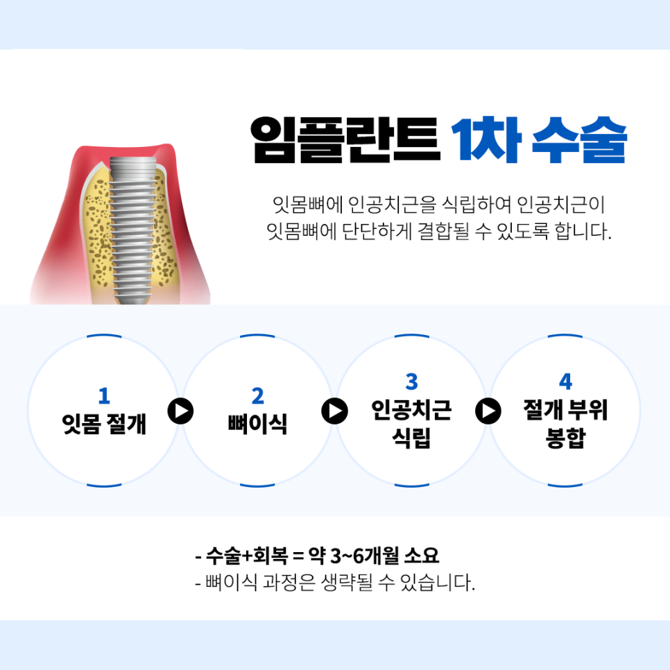임플란트수술 기간 이거 하나로 정리 끝 관련 이미지 2