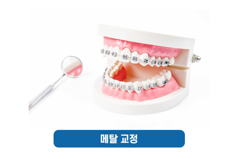 총생 앞니 덧니 발치 후 치아교정? 관련 이미지 7