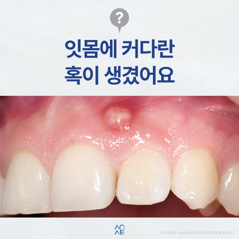 Could the Lump on My Gums Be Related to the Molar Crown? image 1