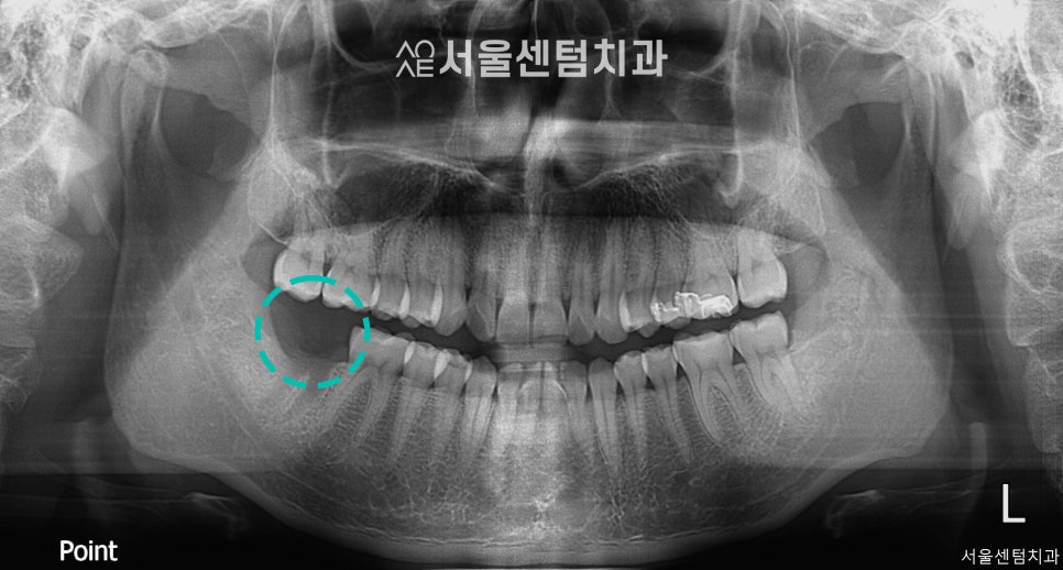 A Successful Molar Implant Case in a Patient in Their 20s image 6