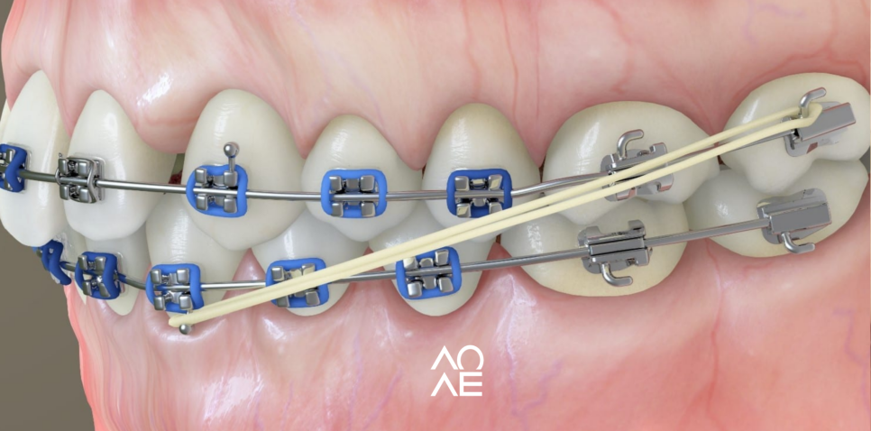 강남치아교정잘하는 교정 고무줄 통증 주의사항 관련 이미지 6