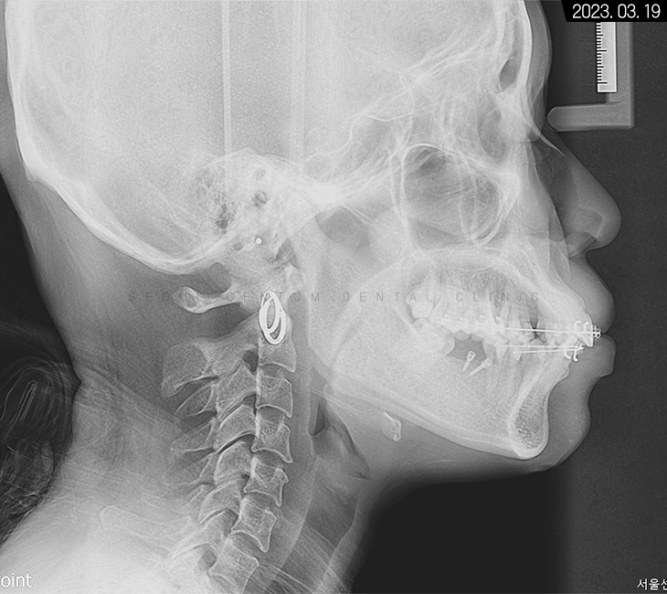 돌출입 및 신경치료와 임플란트 식립 동시 진행 증례 관련 이미지 16
