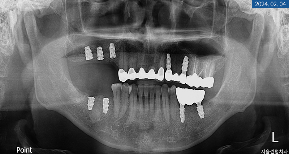 임플란트 브릿지와 크라운 수복으로 치아 기능을 회복시킨 증례 관련 이미지 16