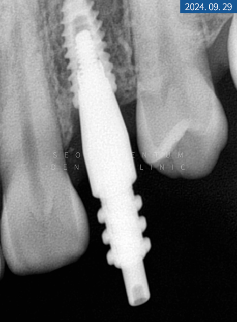 뼈이식 임플란트와 라미네이트 수복 증례 소개 관련 이미지 14