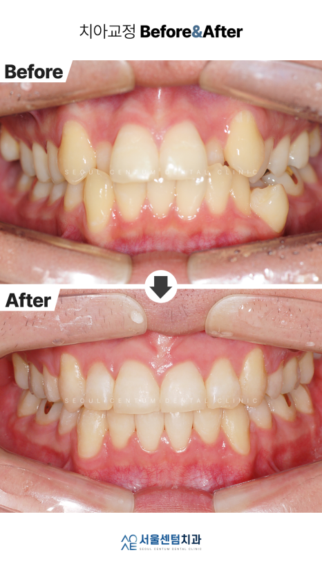 클리피씨 교정 이러한 경우라면 추천 관련 이미지 6
