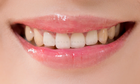 임플란트1개가격 어느 치과든 상관없이 천차만별인 이유 6가지 관련 이미지 2