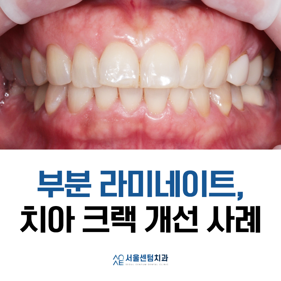 라미네이트전후 치아의 가지런한 정도와 밝기 차이 확인하기 관련 이미지 1