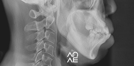 잠원동 교정 반대교합 크라운 치료도 가능합니다. 관련 이미지 4