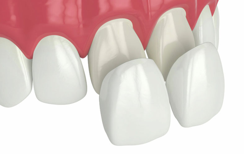 잠원동치과 무삭제 라미네이트 기간 앞니 깨짐 관련 이미지 8