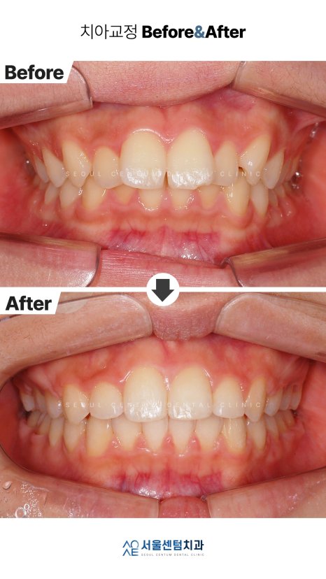 클리피씨 교정 이러한 경우라면 추천 관련 이미지 5