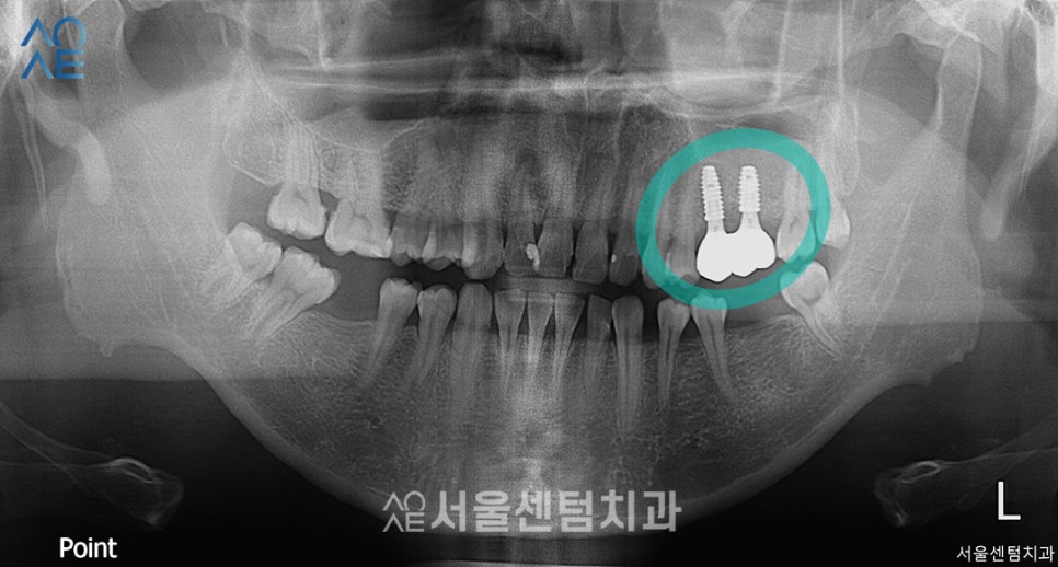 상악동수술 동반한 임플란트 진행한 이야기 관련 이미지 5