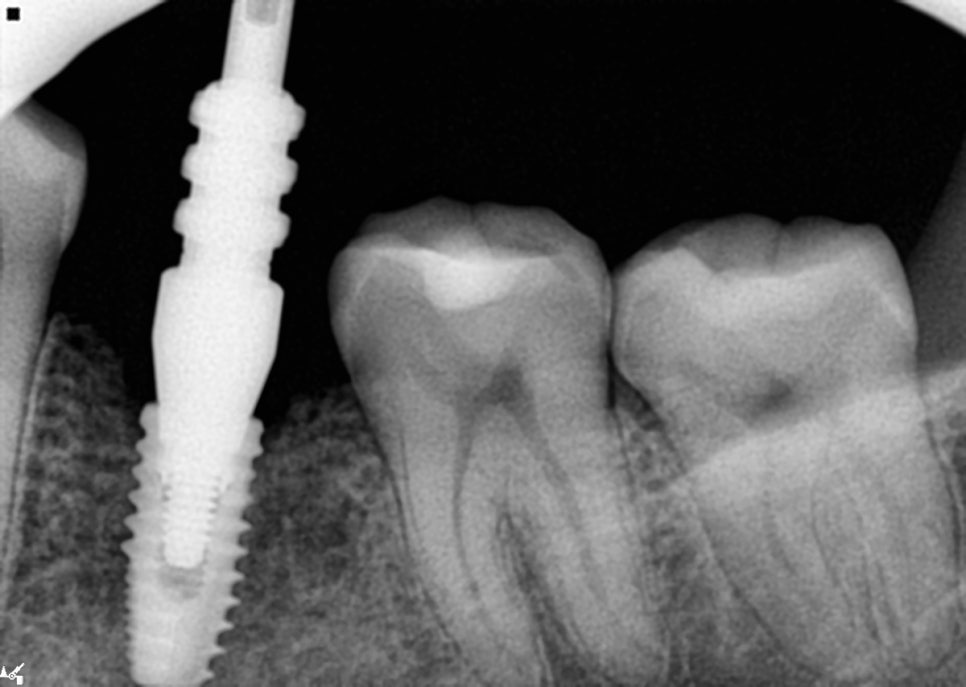 40대 임플란트 치료 케이스 상악동거상술 골이식까지 관련 이미지 9