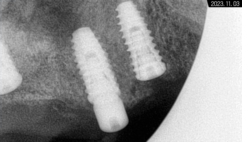 전체임플란트 기간 예상보다 줄어들 수 있는 방법과 증례 공개 관련 이미지 12