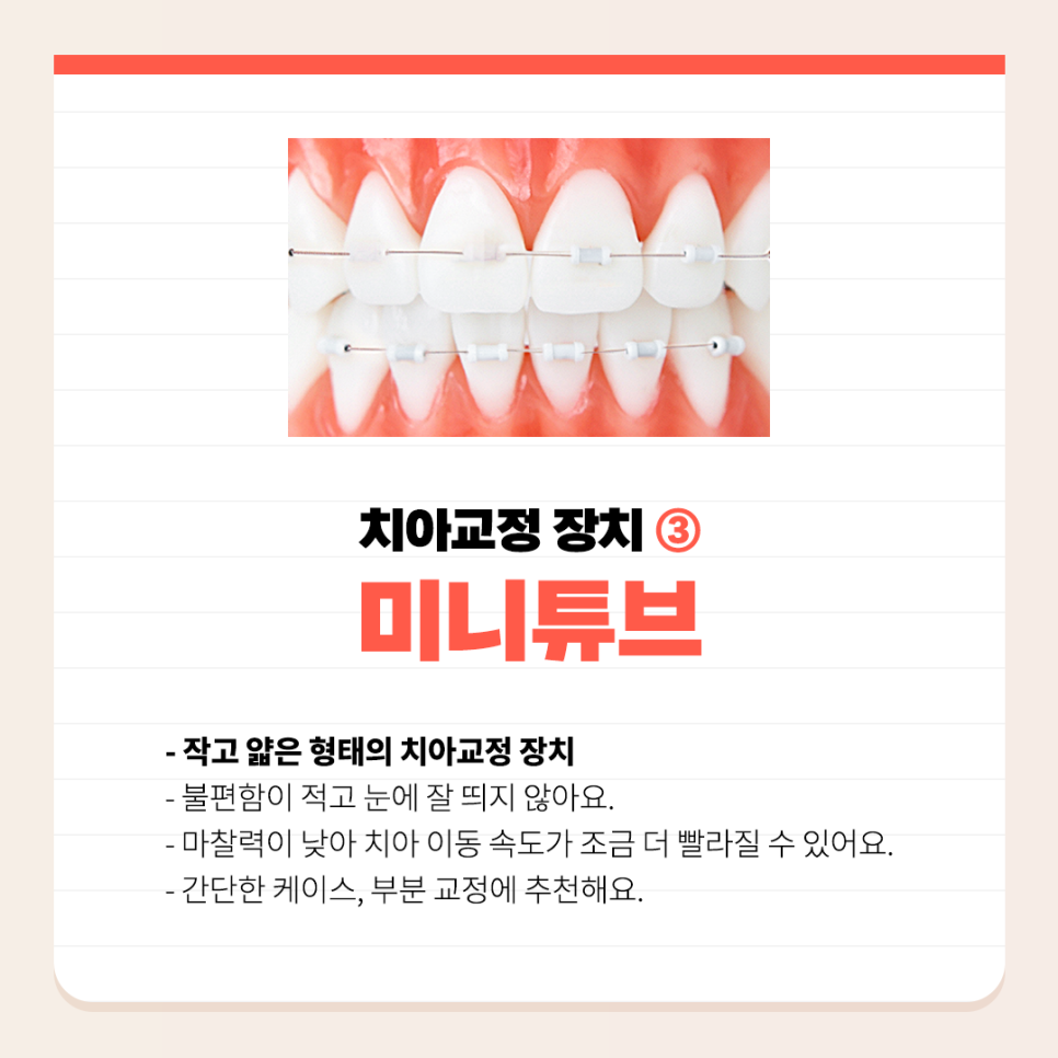 치아교정장치 종류 하나하나 알려드려요 관련 이미지 4
