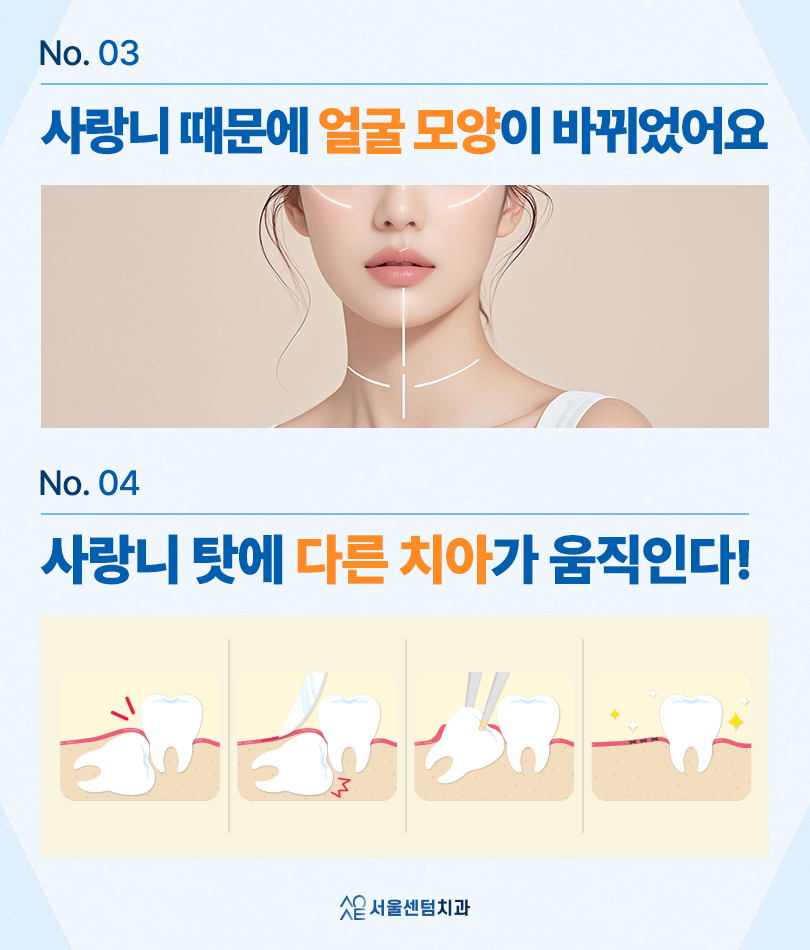 사랑니 발치 후 관련 이미지 3