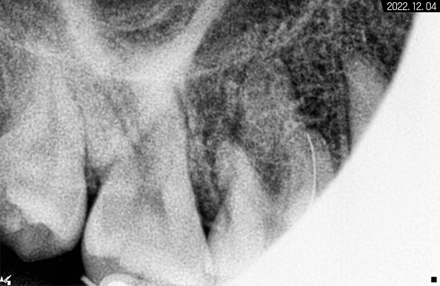 돌출입 및 신경치료와 임플란트 식립 동시 진행 증례 관련 이미지 7