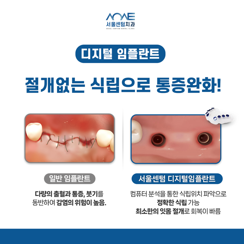 발치 후 임플란트 꼭 해야하는 이유 (잇몸뼈 소실, 쓰러짐, 정출) 관련 이미지 7