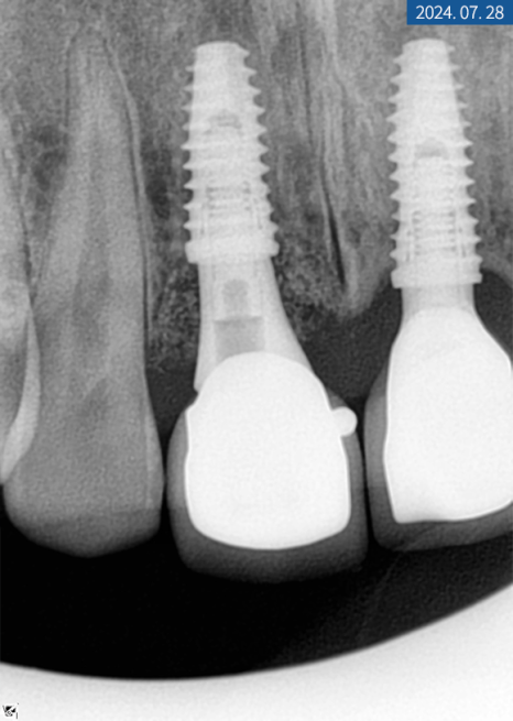 앞니 임플란트 식립으로 저작 기능을 끌어올린 증례 관련 이미지 13
