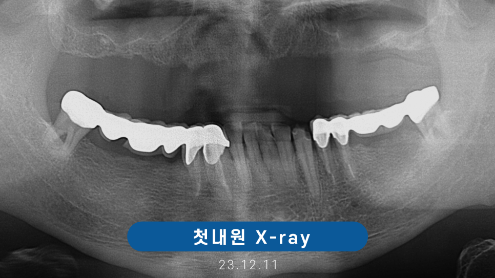 전체임플란트 노인틀니 보험 실비 비용 관련 이미지 4